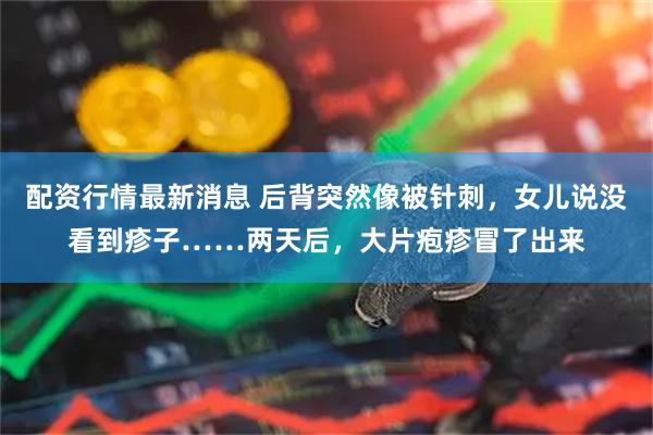 配资行情最新消息 后背突然像被针刺，女儿说没看到疹子……两天后，大片疱疹冒了出来